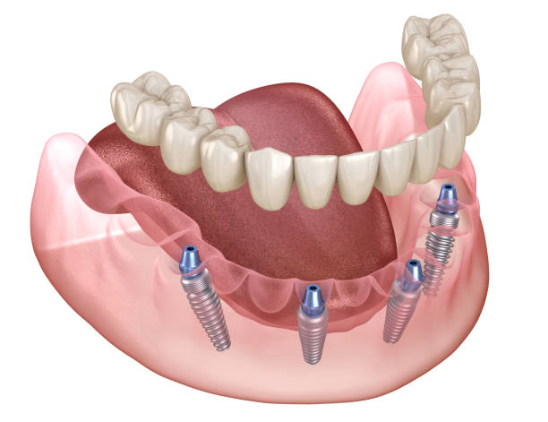 prothèse dentaire fixe sur quatre implants