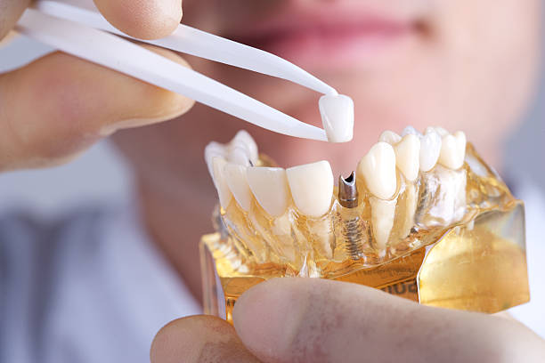prix des implants dentaires au Portugal