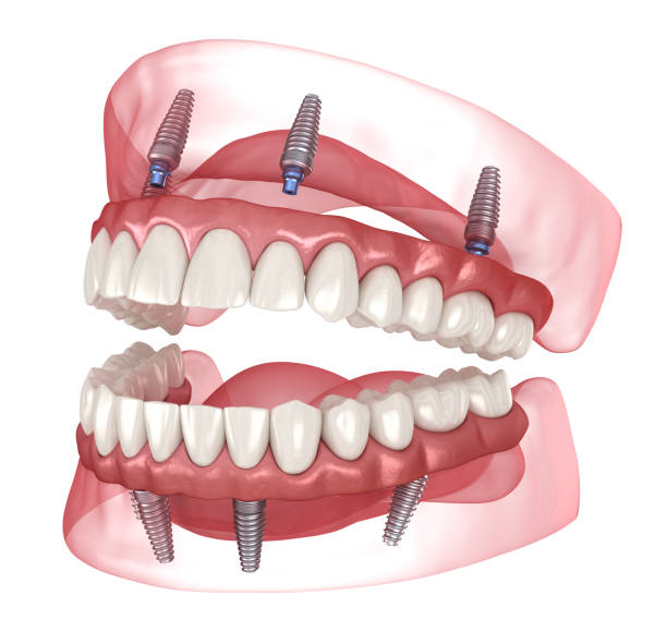 All-on-4 , la solution idéale pour les pertes de dents