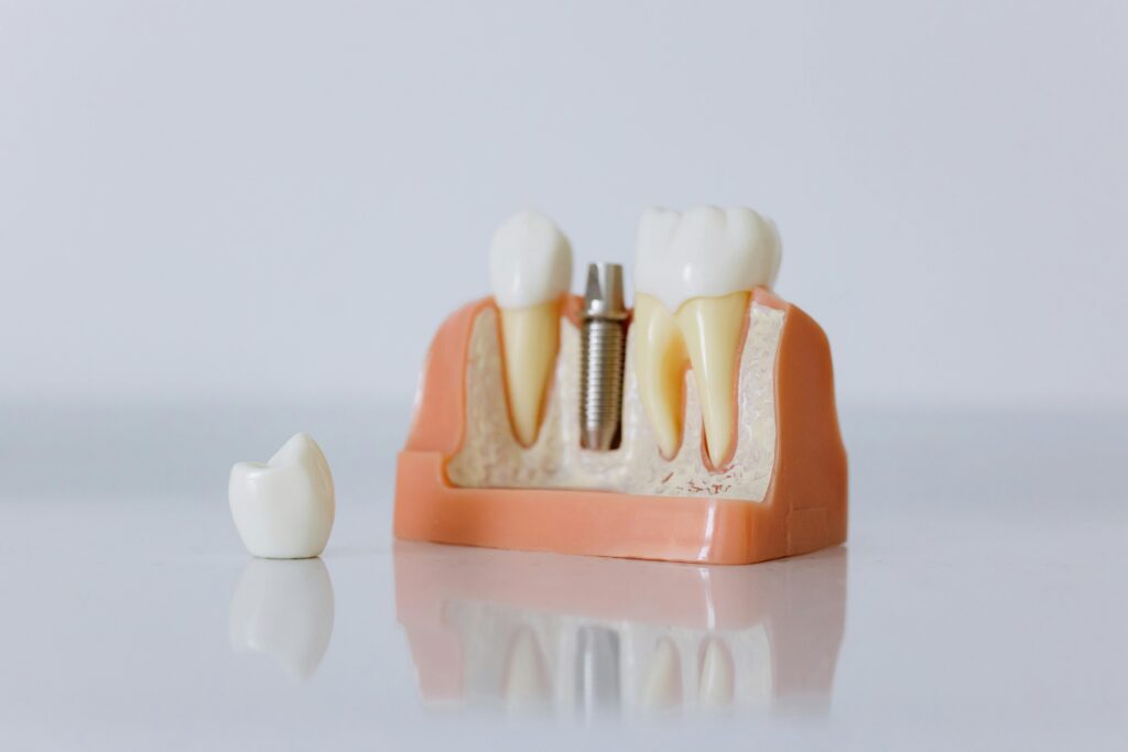 implants dentaires All-on-4